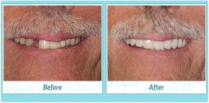 Dental Implants Smile Gallery Image of S.K.