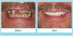 Dental Implants Smile Gallery Image of T.W.