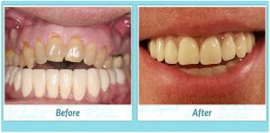 Dental Implants Smile Gallery Image of A.J.