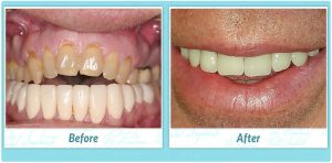 Dental Implants Smile Gallery Image of A.B.