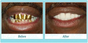 Dental Implants Smile Gallery Image of L.D.