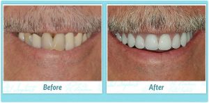 Dental Implant Smile Gallery Image of B.F.