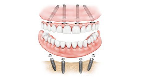 Understanding Teeth In One Day