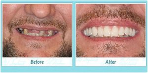 teeth in one day before and after image