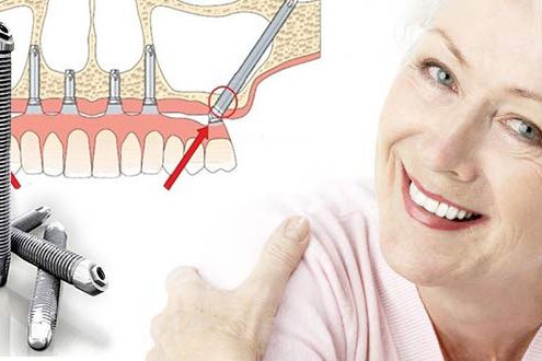 Get Rid Of False Teeth Risks With All On 4 Dental Implants Florida