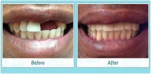 All-on-4 dental implants before and after image smile gallery