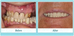 teeth in a day before and after image