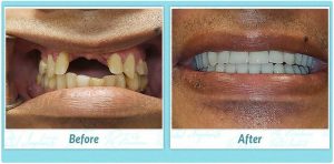 All on 4 dental implant surgery smile gallery before and after