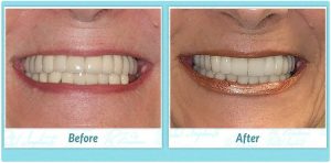 denture replacement implants before and after