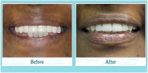 denture replacement before and after image