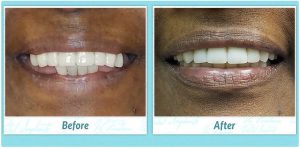 denture replacement before and after image