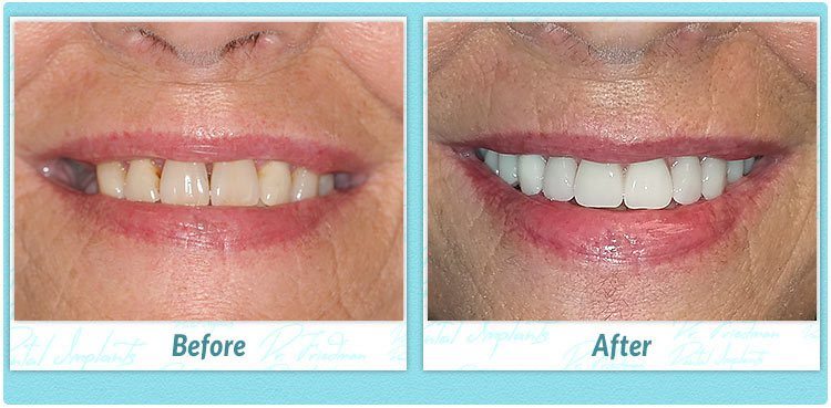 Bone Formation Around Dental Implants | OneSolution Dental Implants