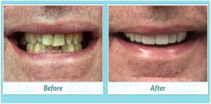 dental implant patient case 556 before and after